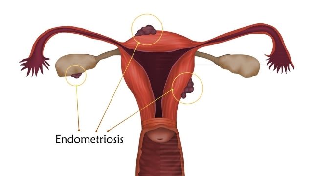 All About Endometriosis | Shree IVF Clinic - Dr. Jay Mehta