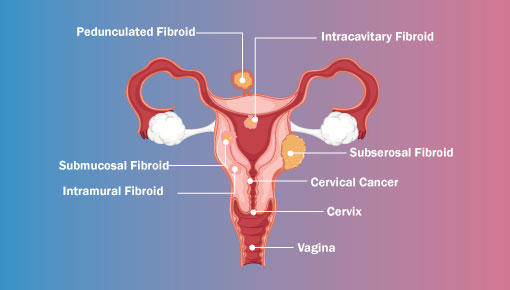 Vaginal Discharge and Ovarian Cancer: What To Look For