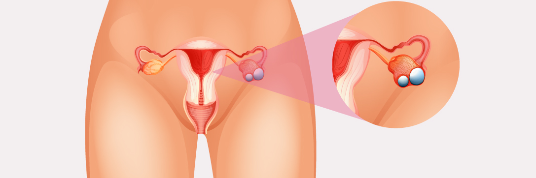Ovarian Cancer image