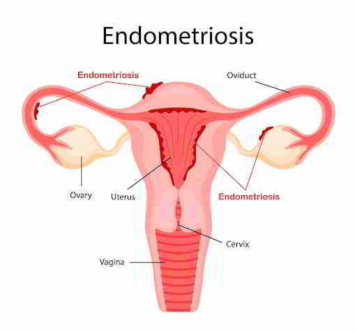 Endometriosis picture