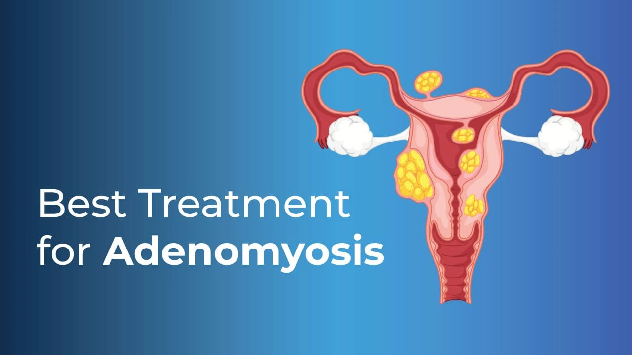 What Is the Best Treatment for Adenomyosis?