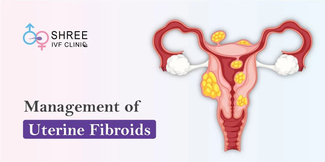 All about the Management of Uterine Fibroids