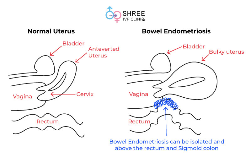 Bowel-Endometriosis Focal Adenomyosis