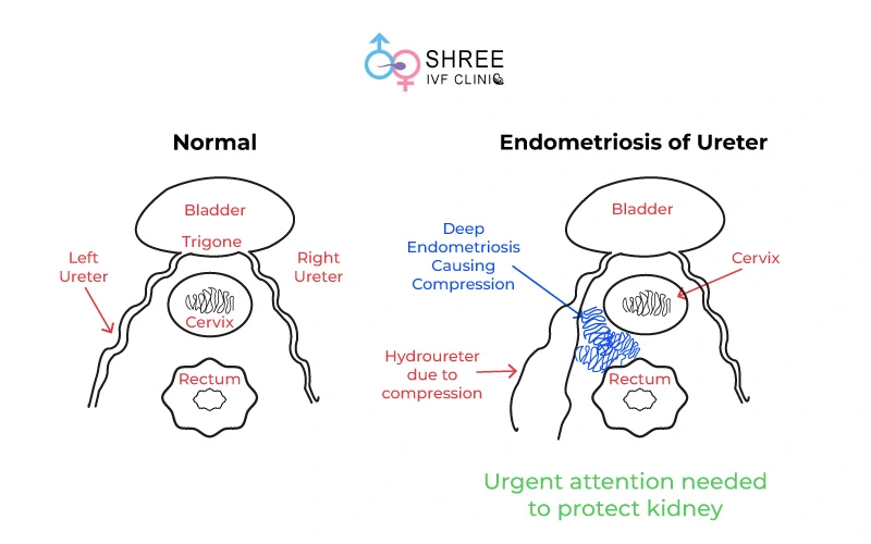 Image including difference between Normal uterus vs Globular adenomyosis uterus