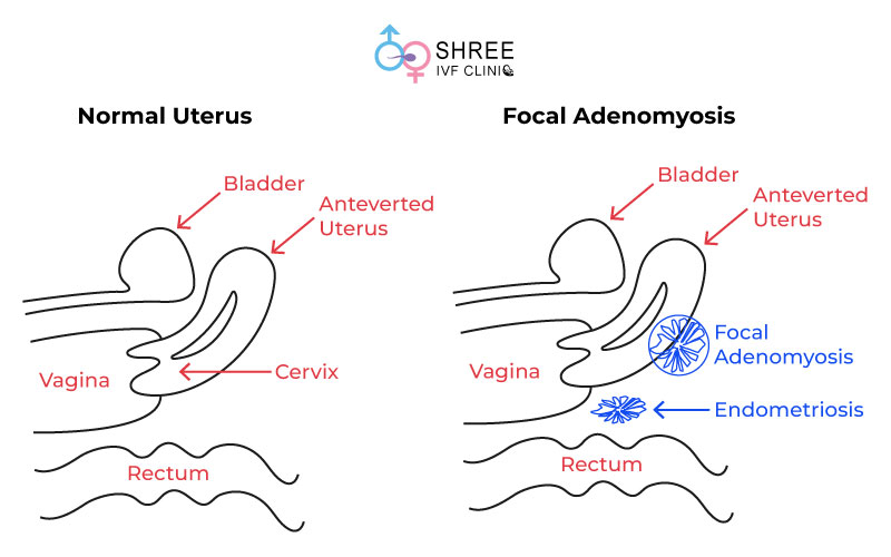 Focal Adenomyosis Focal Adenomyosis