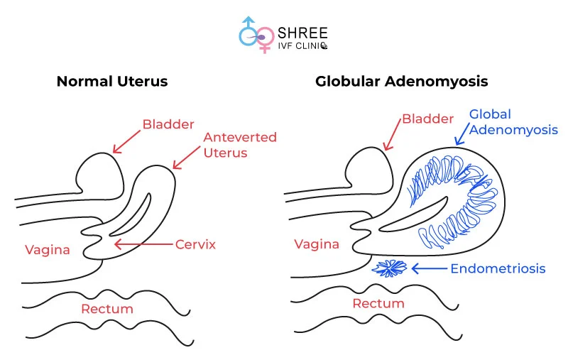 Globular Adenomyosis Endometriosis Clinic In Mumbai Globular Adenomyosis Endometriosis Clinic In Mumbai