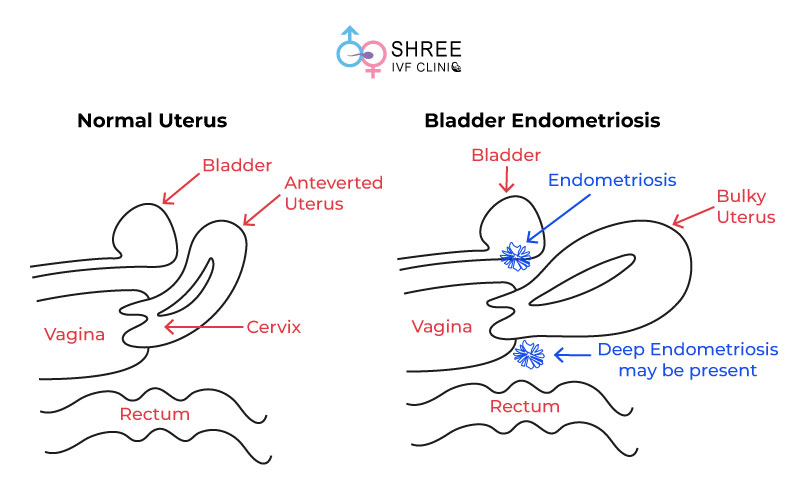 Image including difference between Normal uterus vs Globular adenomyosis uterus