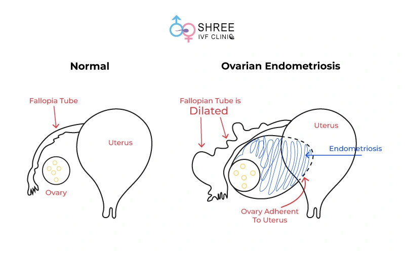 Ovarian Endometriosis Image including difference between Normal uterus vs Globular adenomyosis uterus