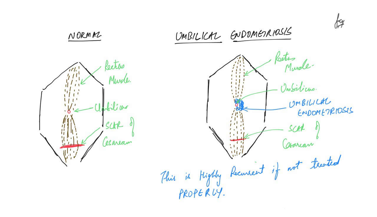 Natural Healing - Umbilical Endometriosis. Bleeding 🩸 through the