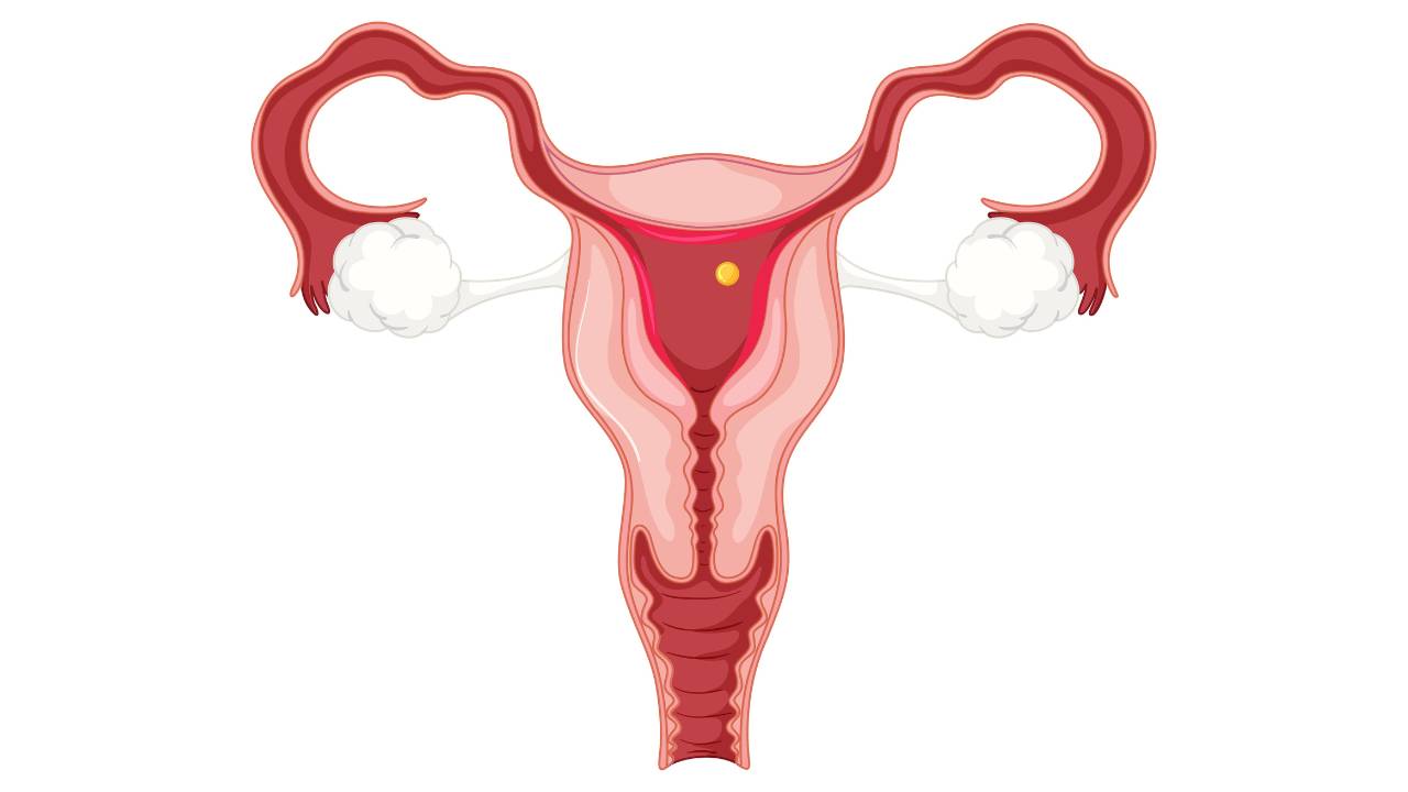 All About Endometriosis | Shree IVF Clinic - Dr. Jay Mehta