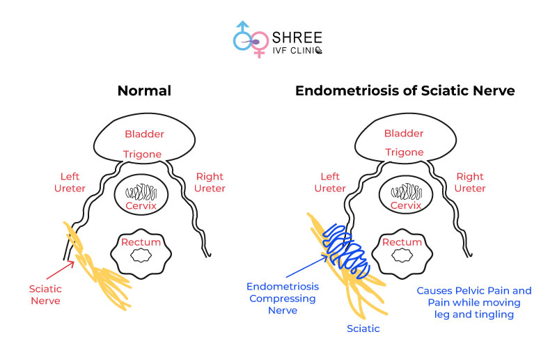 Sciatic nerve endometriosis