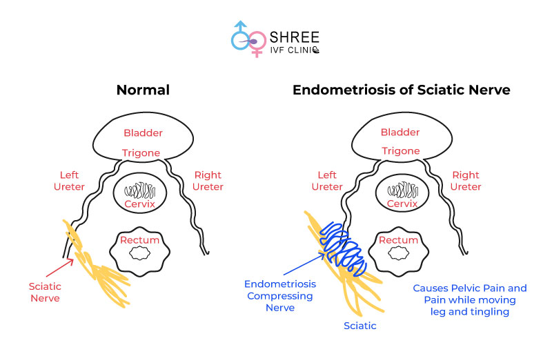 Endometriosis-of-Sciatic-Nerve Sciatic nerve endometriosis