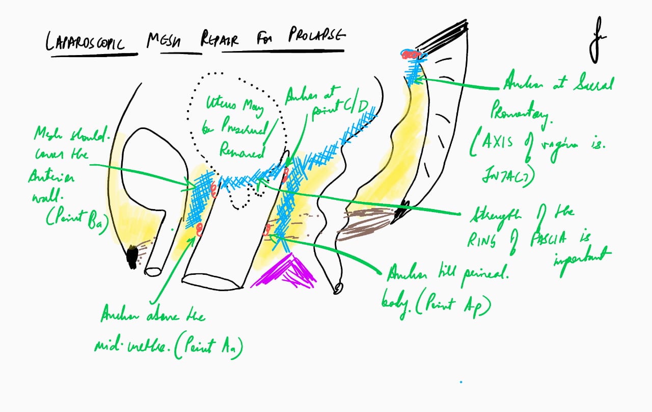 Laparoscopic surgery for Prolapse with Mesh