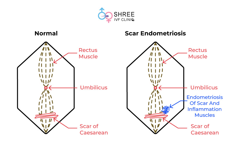 scar endometriosis treatment in Mumbai
