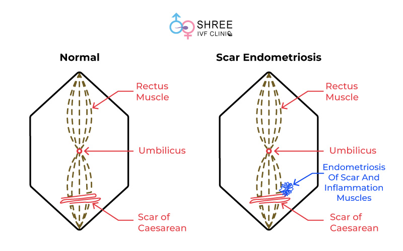 Scar Endometriosis scar endometriosis treatment in Mumbai