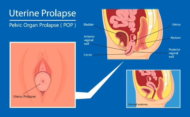 Uterine Prolapse During Pregnancy: Risks, Symptoms & Care