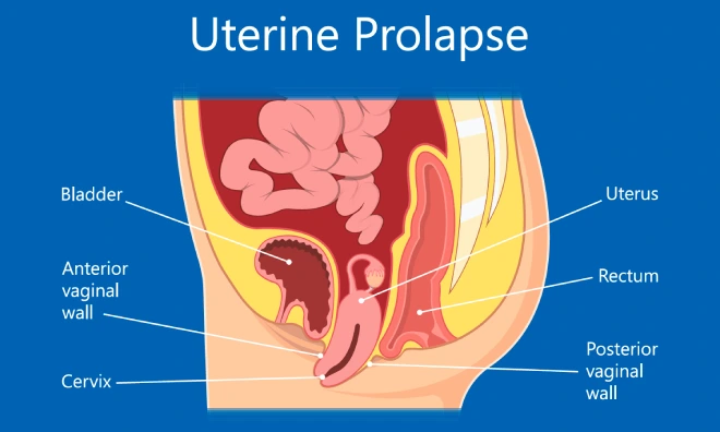 Uterine Prolapse During Pregnancy: Risks, Symptoms & Care