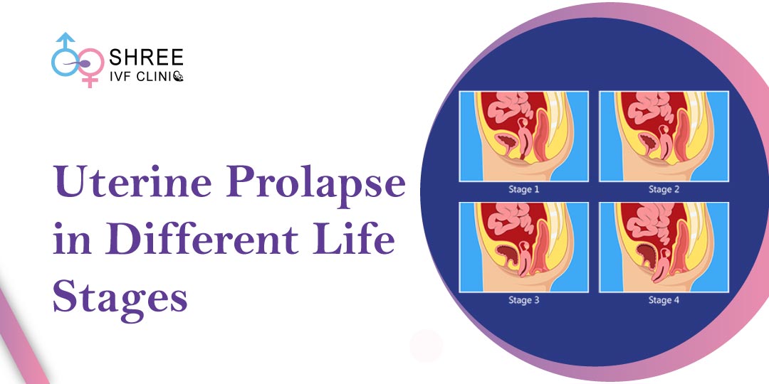 Uterine Prolapse: How it Affects Women at Different Life Stages