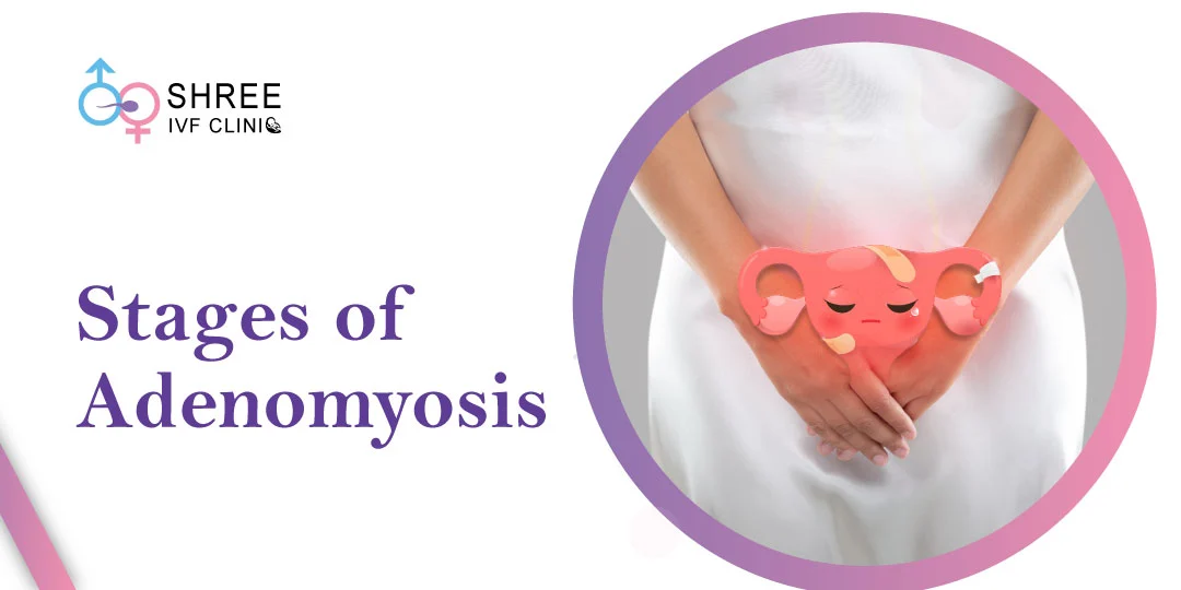 Adenomyosis Stages Adenomyosis Stages