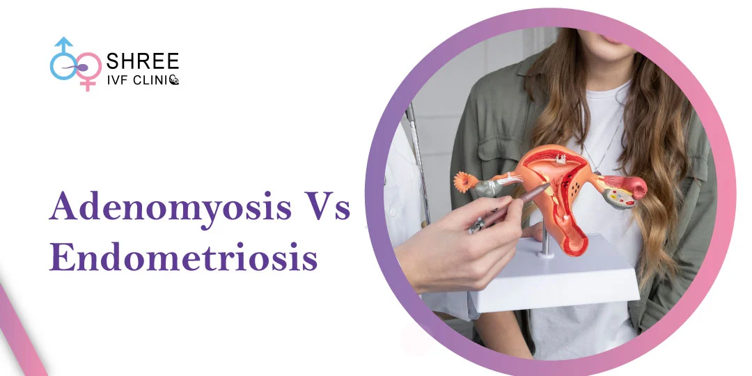 Difference Between Adenomyosis and Endometriosis