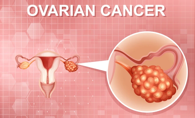 How to Check for Ovarian Cancer at Home? – Dr. Jay Mehta