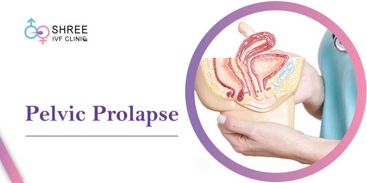 Pelvic Prolapse: Causes, Symptoms, Treatment and Prevention