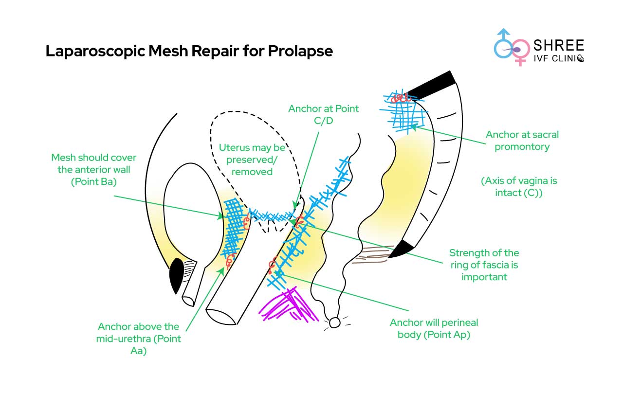 Laparoscopic Mesh Repair for Prolapse