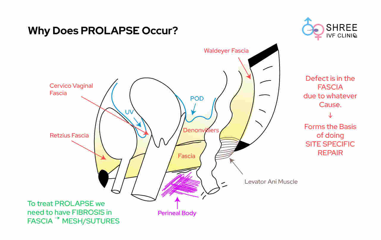 Why Does Prolapse Occur