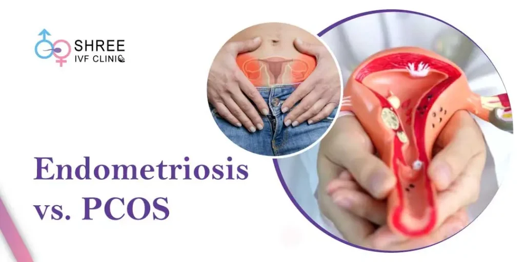 Difference Between Endometriosis and PCOS