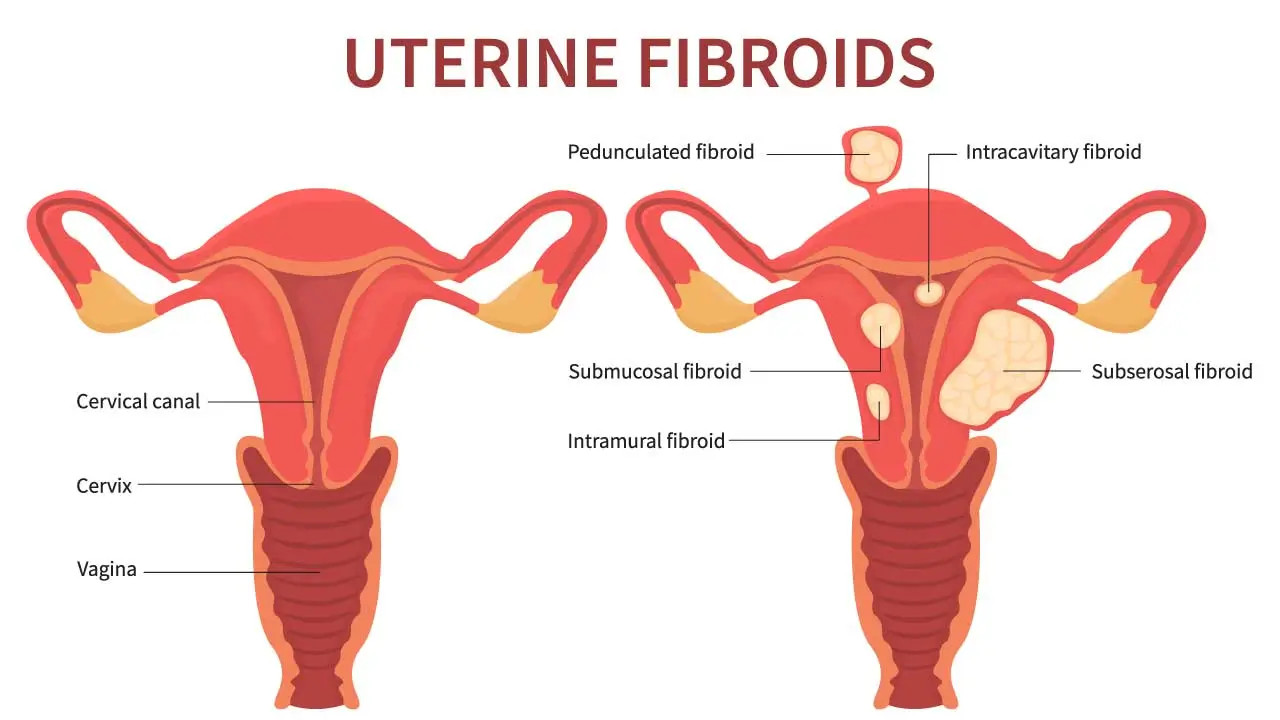 Uterine Fibroid treatment Mumbai