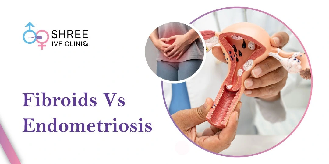 How Is Endometriosis Different From Fibroids?