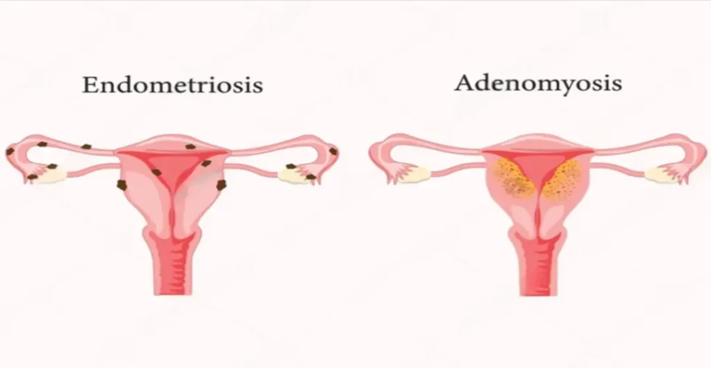 Endometriosis and Adenomyosis