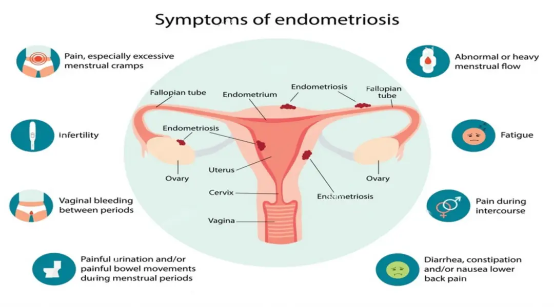 endometriosis symptoms