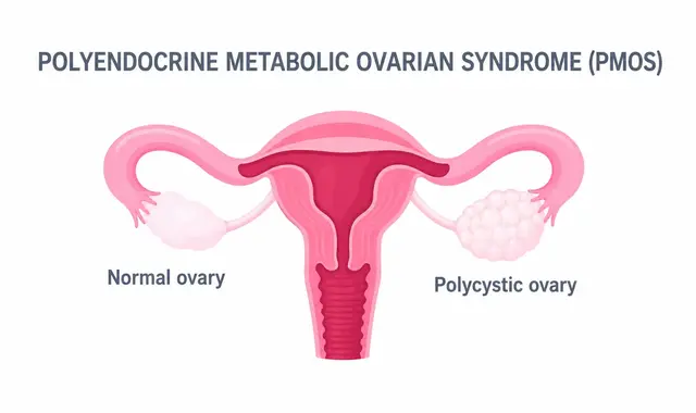 What is Polyendocrine Metabolic Ovarian Syndrome PMOS