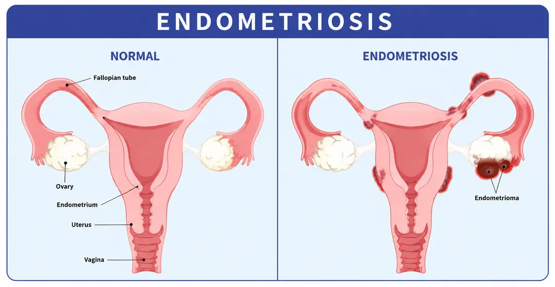 Endometriosis Treatment in India