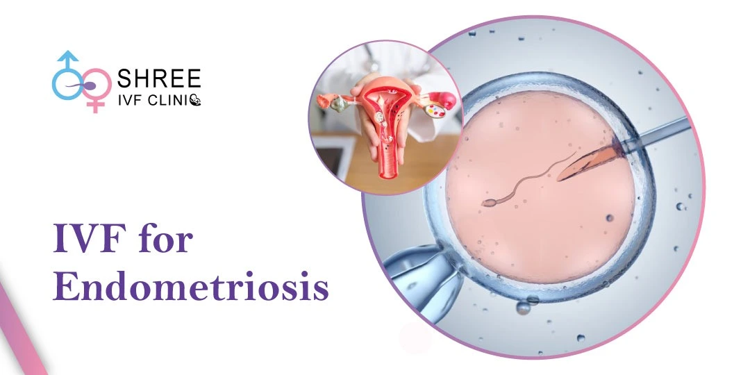 IVF for Endometriosis