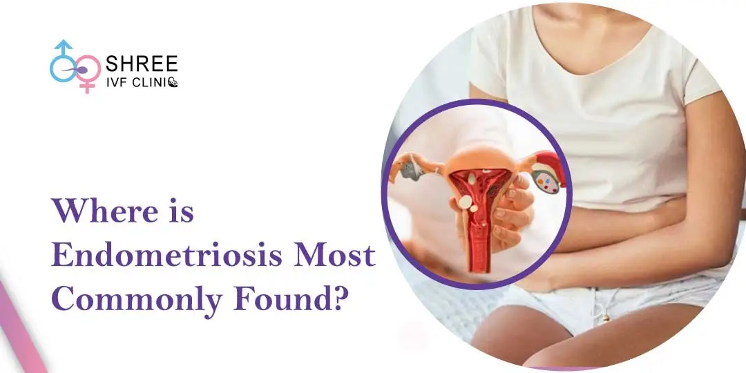 Where does Endometriosis Occur?
