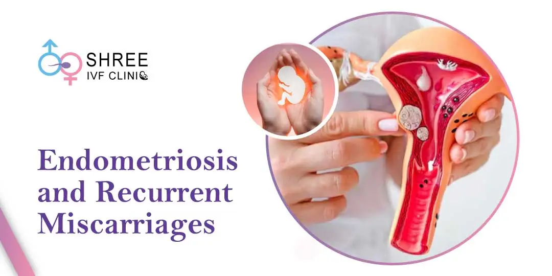 Link Between Endometriosis and Recurrent Miscarriage