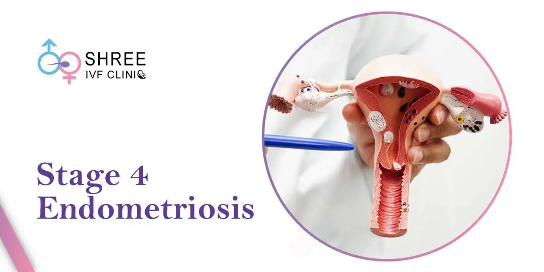 Endometriosis Stage 4